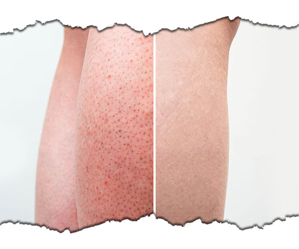 epilare cu laser