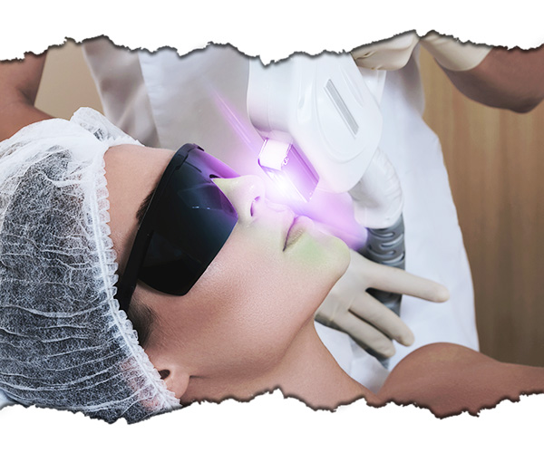 epilare cu laser