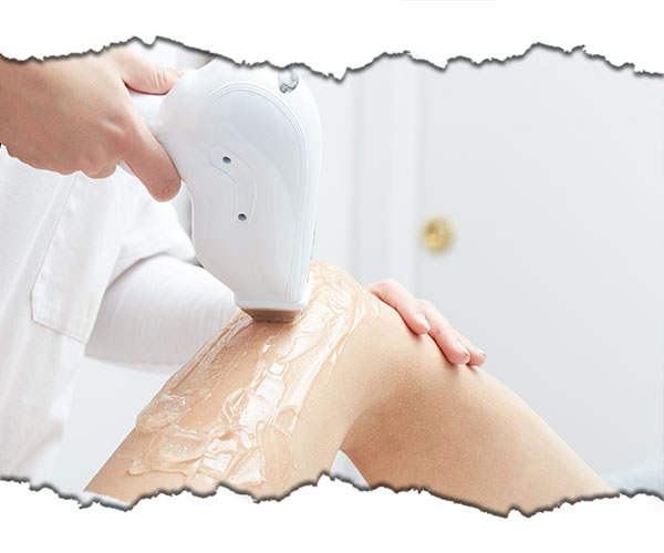 epilare cu laser