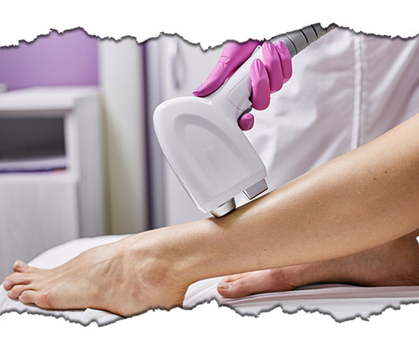 epilare cu laser