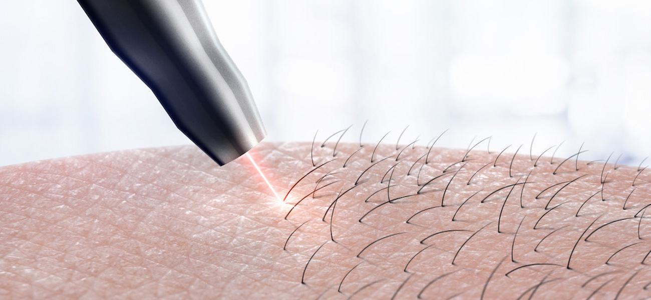 Senzofit - epilare definitiva laser