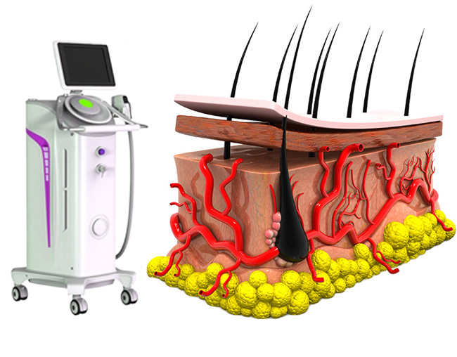 epilare definitiva laser axile