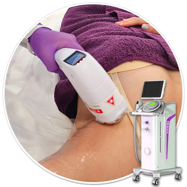 epilare definitiva laser axile