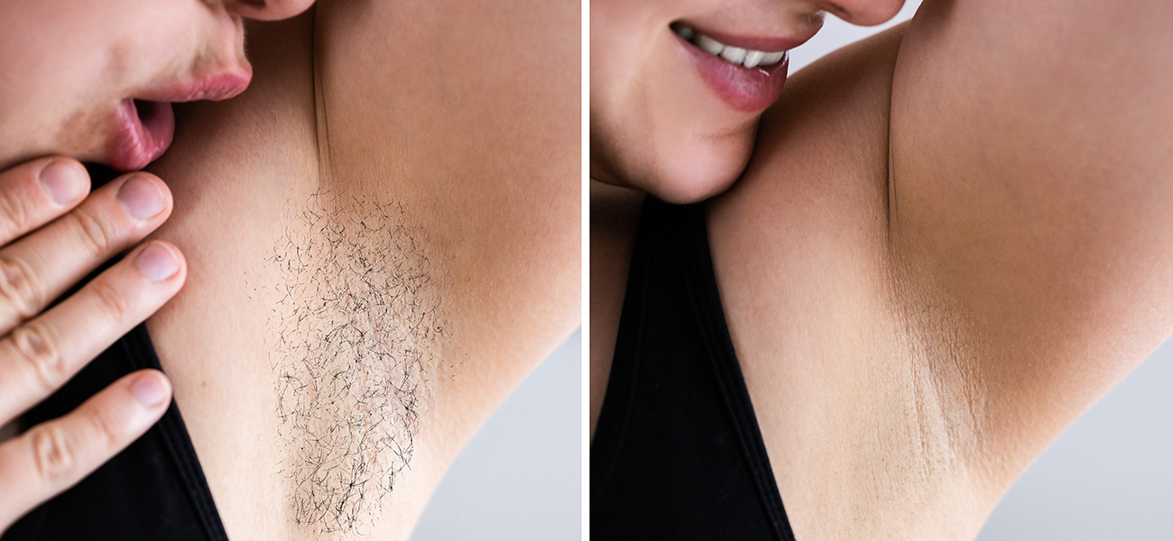 Senzofit - epilare definitiva laser