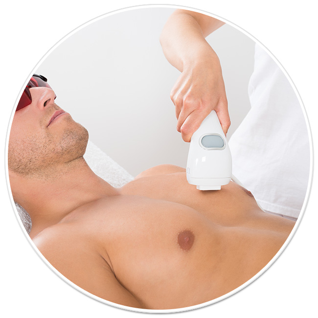 epilare definitiva laser barbati