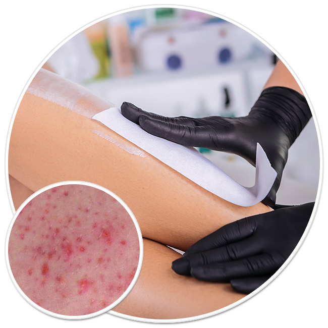 epilare definitiva laser axile