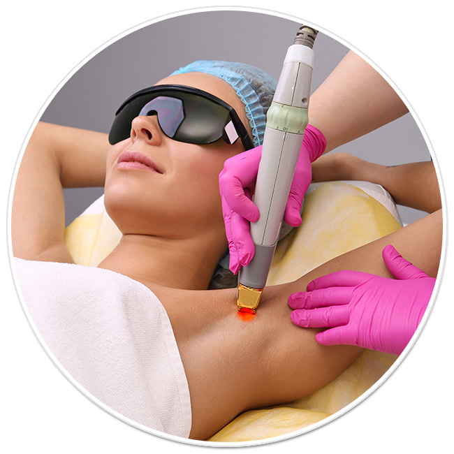 epilare definitiva laser axile